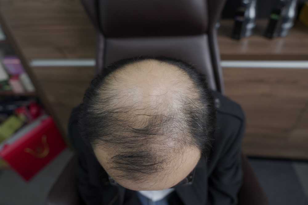 脱发素材 男性 1