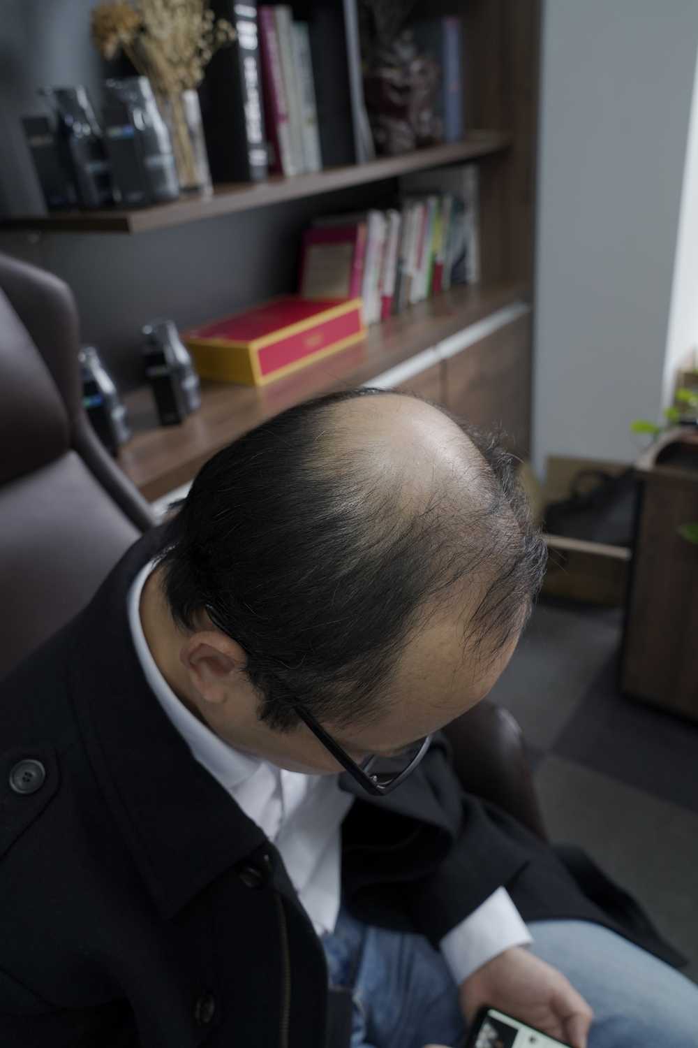 脱发素材 男性 6