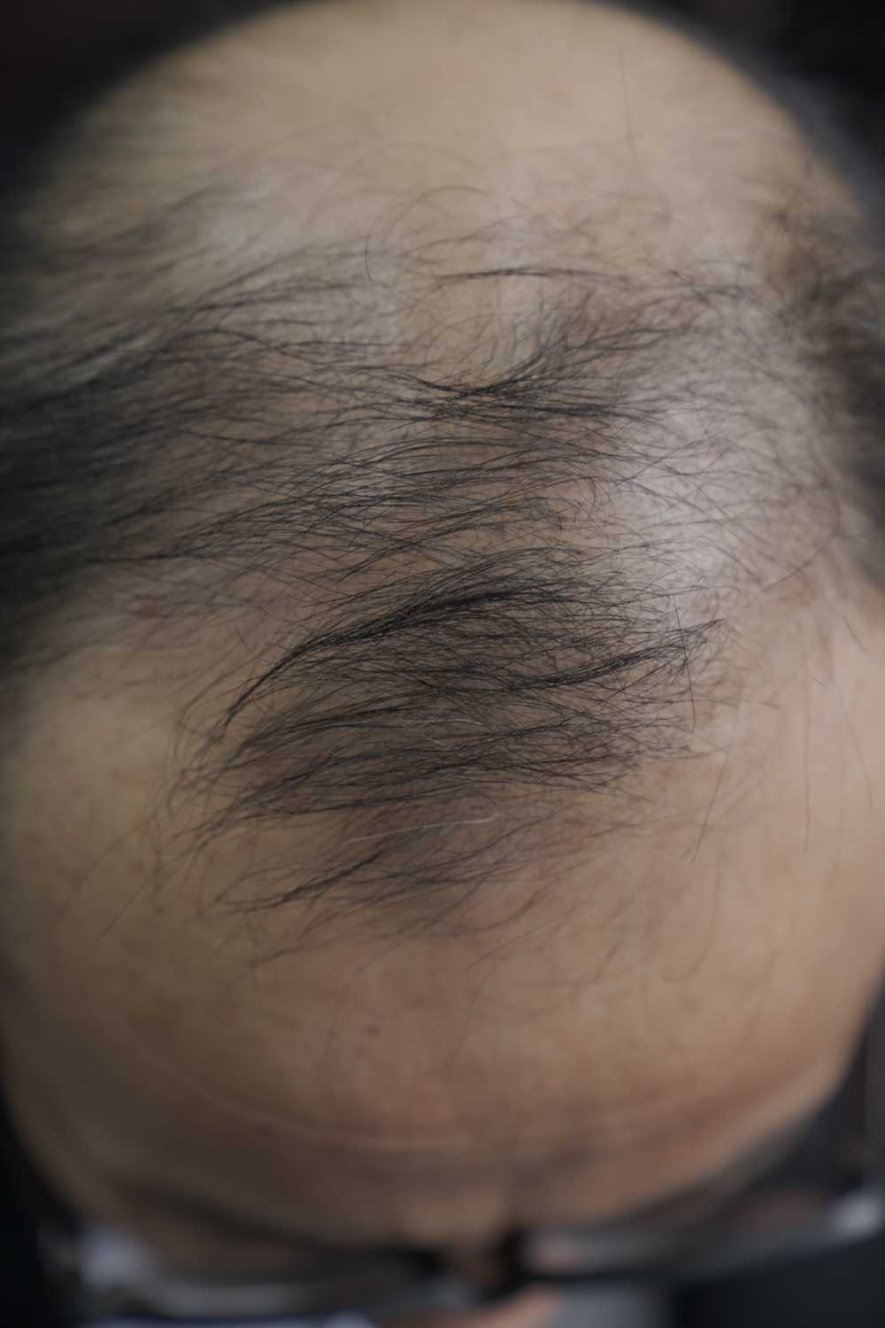 脱发素材 男性 20