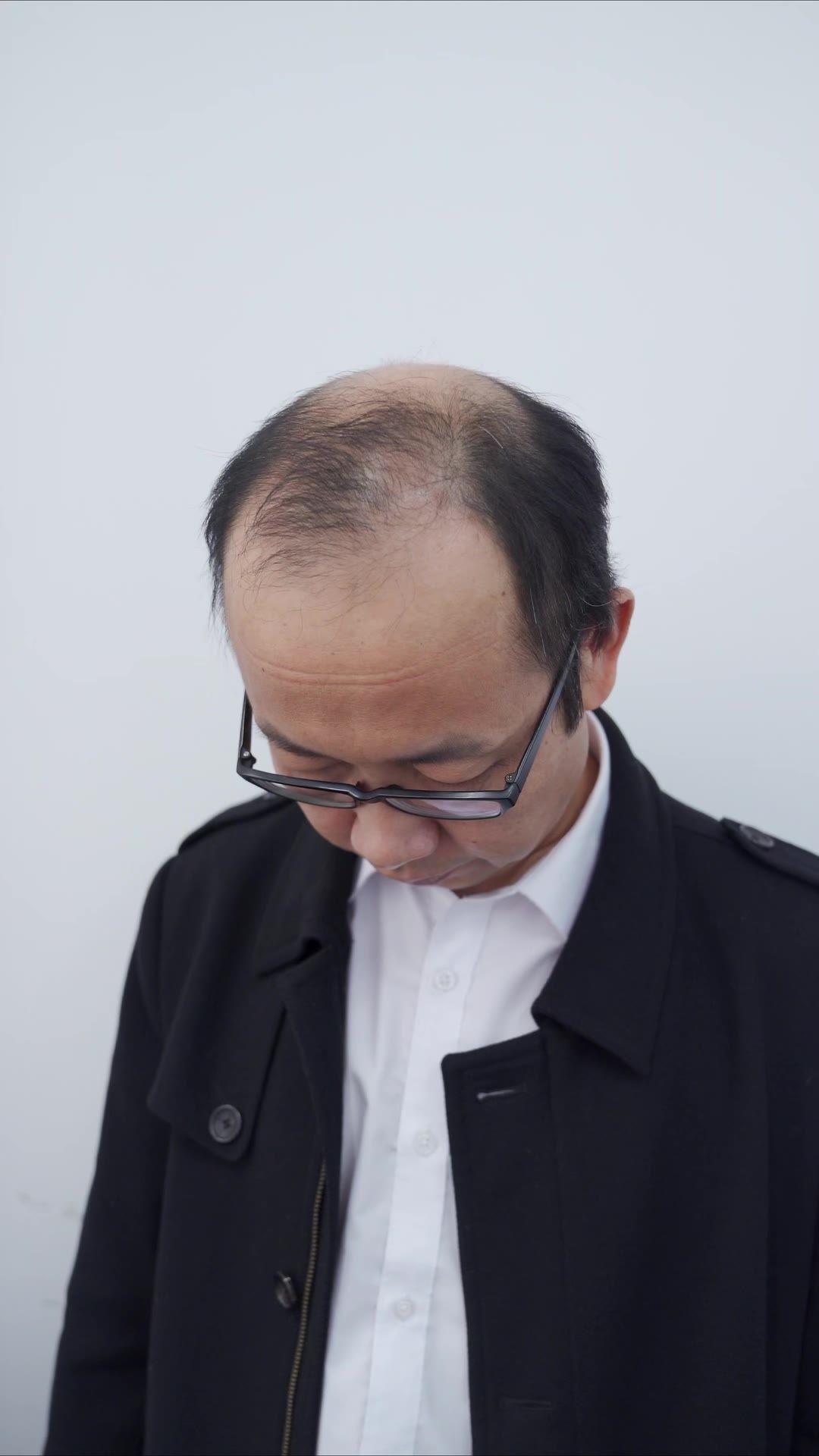 脱发 11