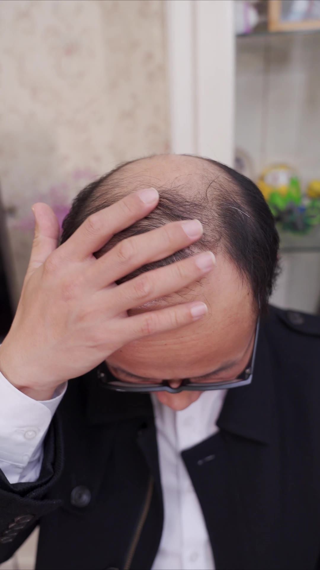 脱发 41